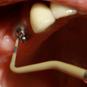 Deppeler perio probe implant